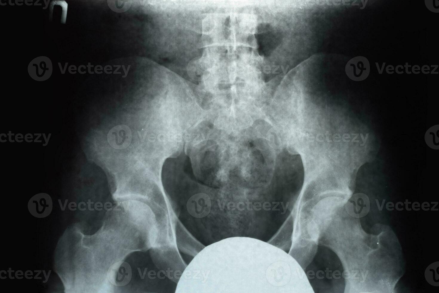 X-ray of the pelvis and sacrum. X-ray photo