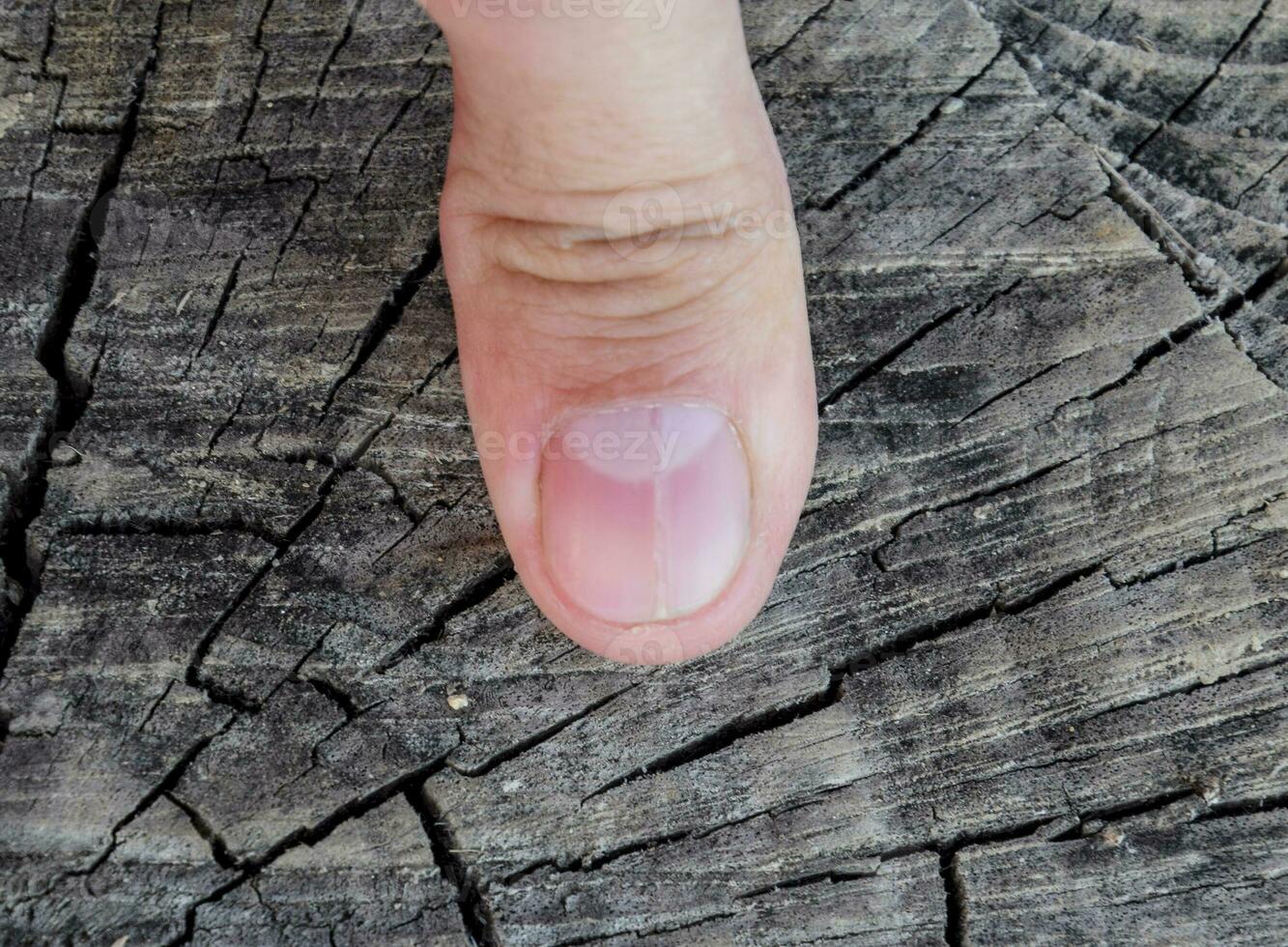 ahorquillado uña en el pulgar. dilatación de el clavo, traumático patología. el uña es dividido en medio foto