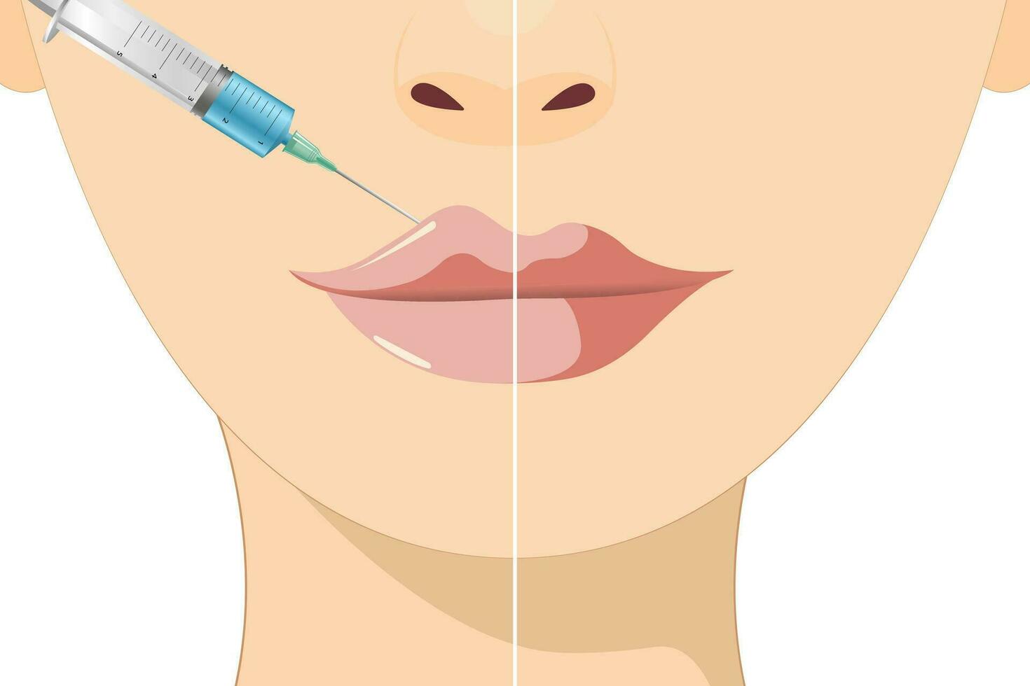 Lip augmentation and correction. Lip filler injections. Hyaluronic acid. Cosmetology procedure in a beauty salon vector