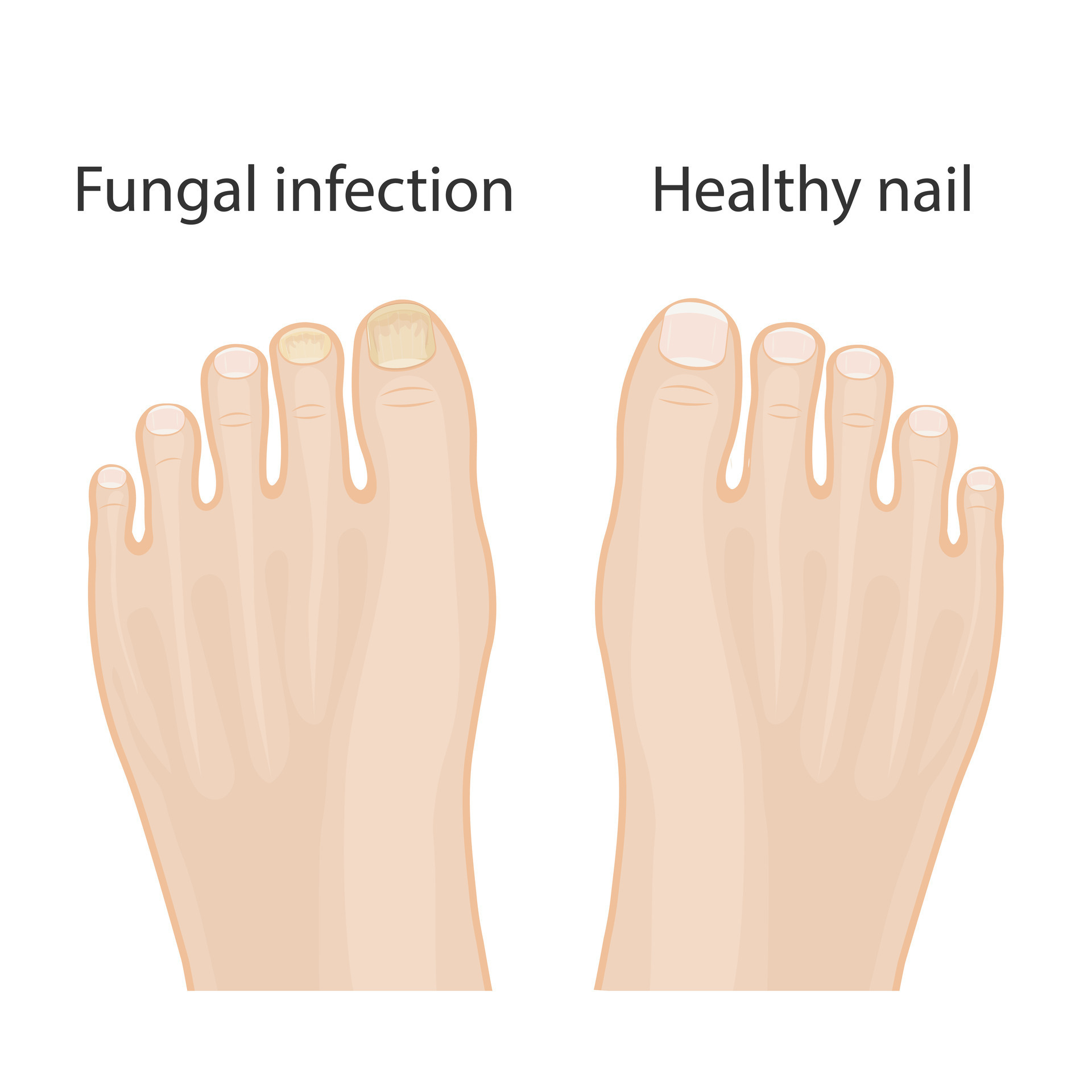 Nail diseases. Onychomycosis, causes of fungal nail infection. Medical ...
