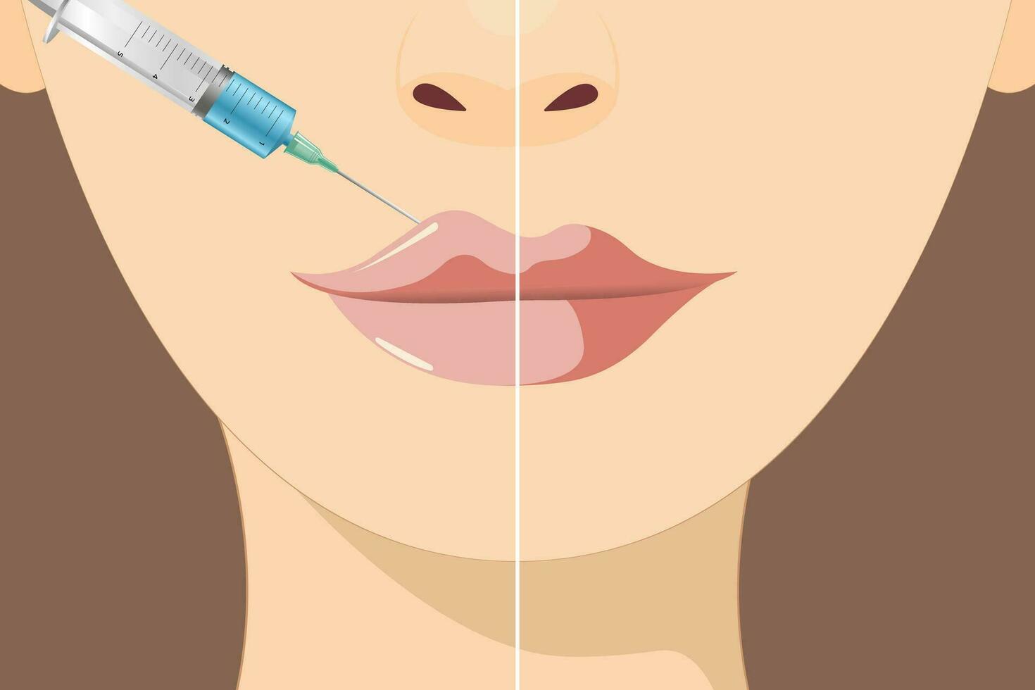 Lip augmentation and correction. Lip filler injections. Hyaluronic acid. Cosmetology procedure in a beauty salon vector