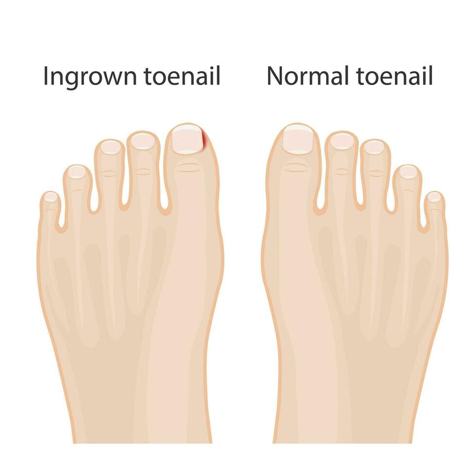 illustration of healthy feet, feet with ingrown toenails, treatment of ingrown toe and toe vector