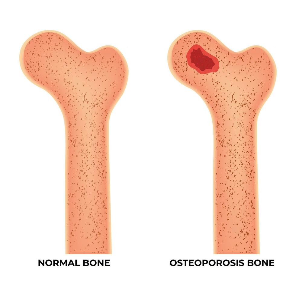 normal hueso y osteoporosis hueso Ciencias diseño vector ilustración