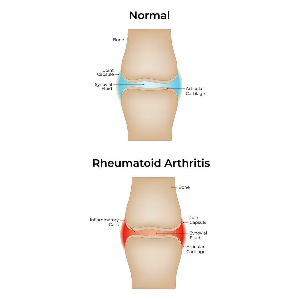 normal y reumatoide artritis Ciencias diseño vector ilustración