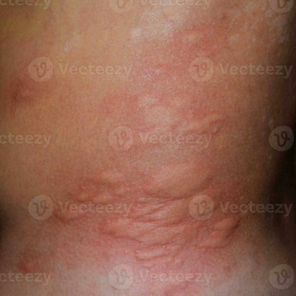 Allergy skin back and sides. Allergic reactions on the skin in the form of swelling and redness photo