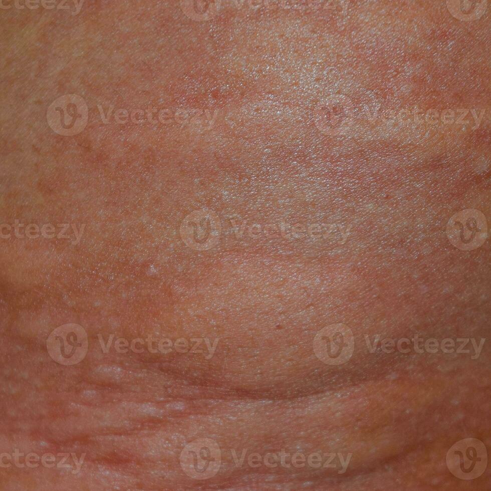 Allergy skin back and sides. Allergic reactions on the skin in the form of swelling and redness photo
