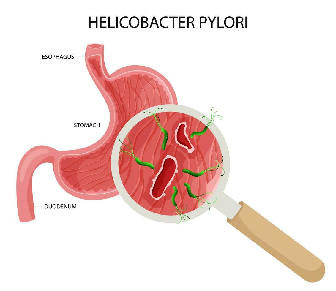 helicobacter pylori en estómago úlcera vector