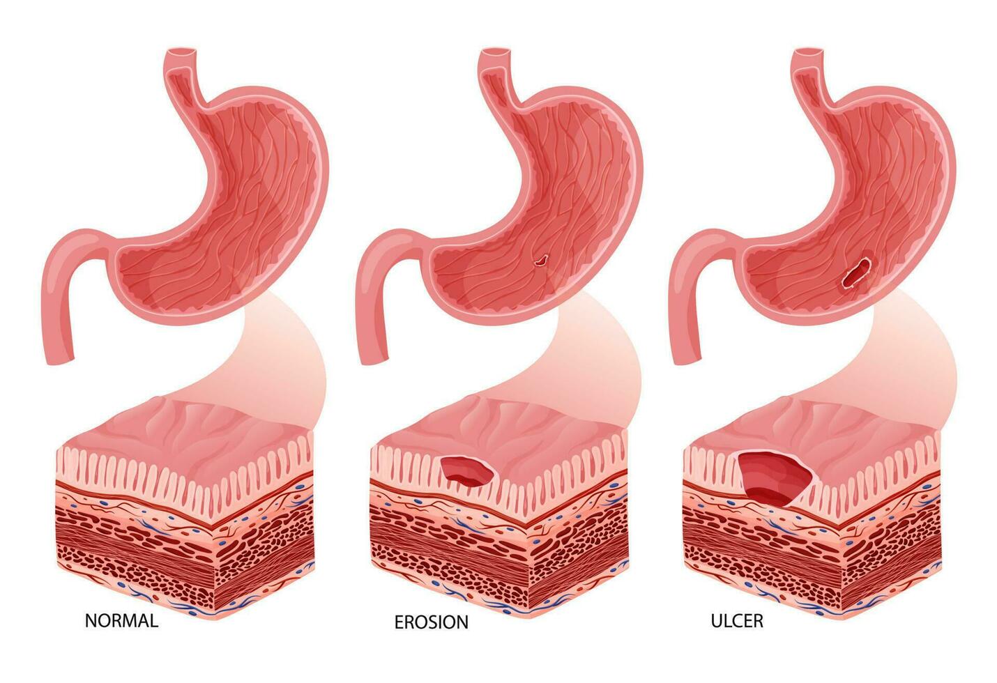 Stomach erosion and ulcer development illustration vector