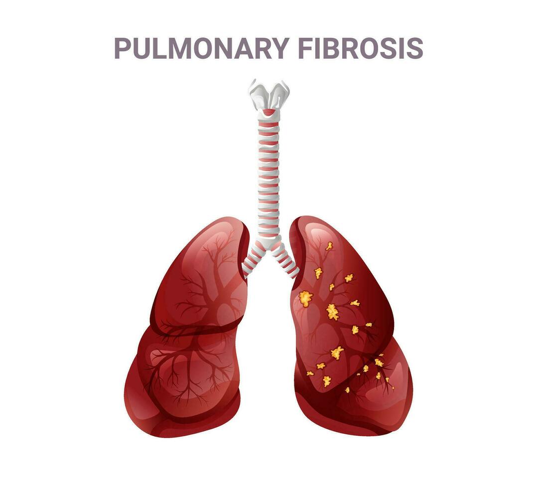 Pulmonary fibrosis and normal lung. Vector illustration isolated on white background