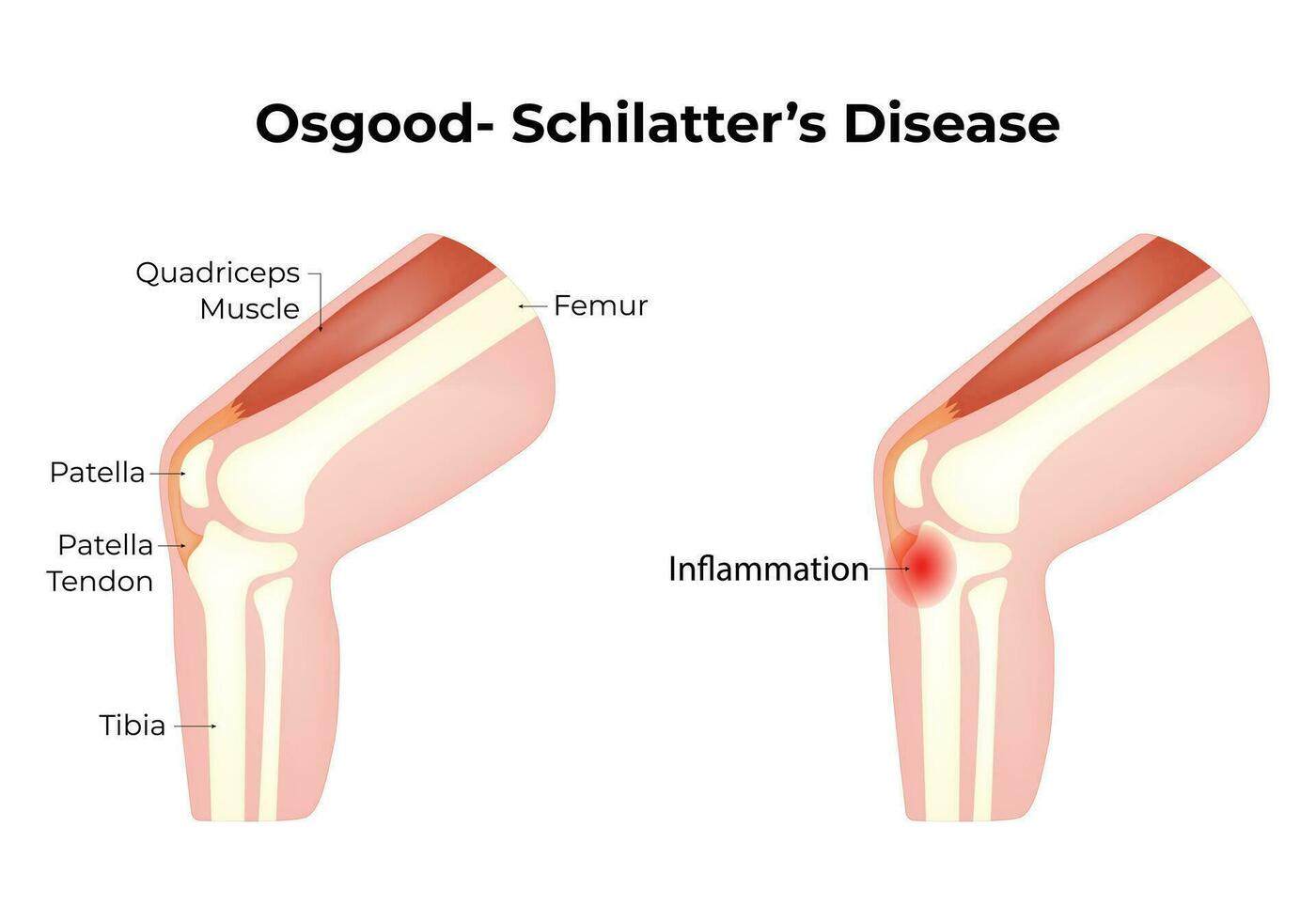 Osgood Schilatters Disease Science Design Vector Illustration