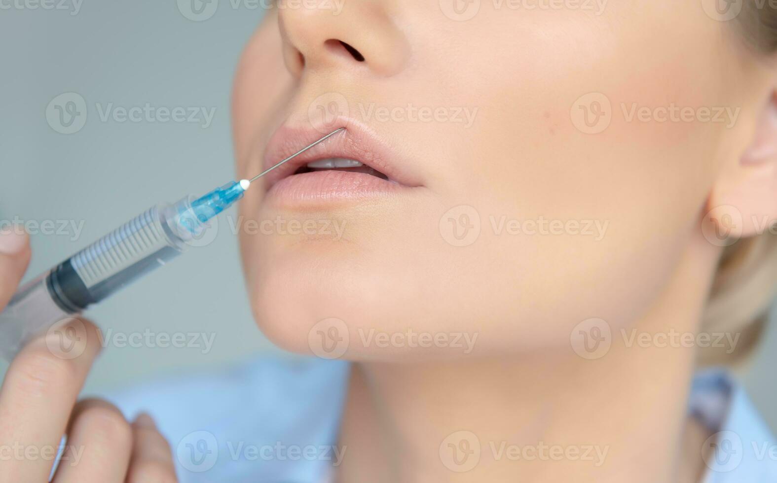 Lip Augmentation in The Clinic photo