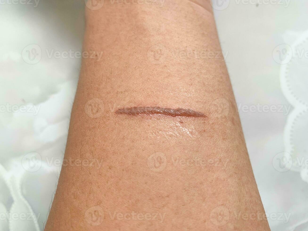 top view of burns wound on hand skin make stright line shape photo