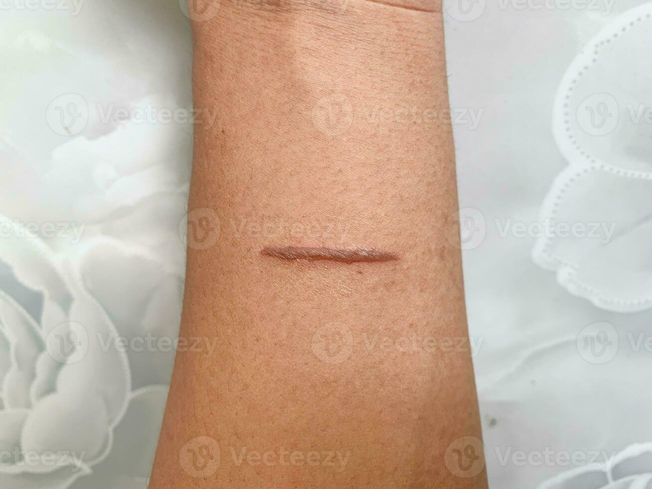 top view of burns wound on hand skin make stright line shape photo