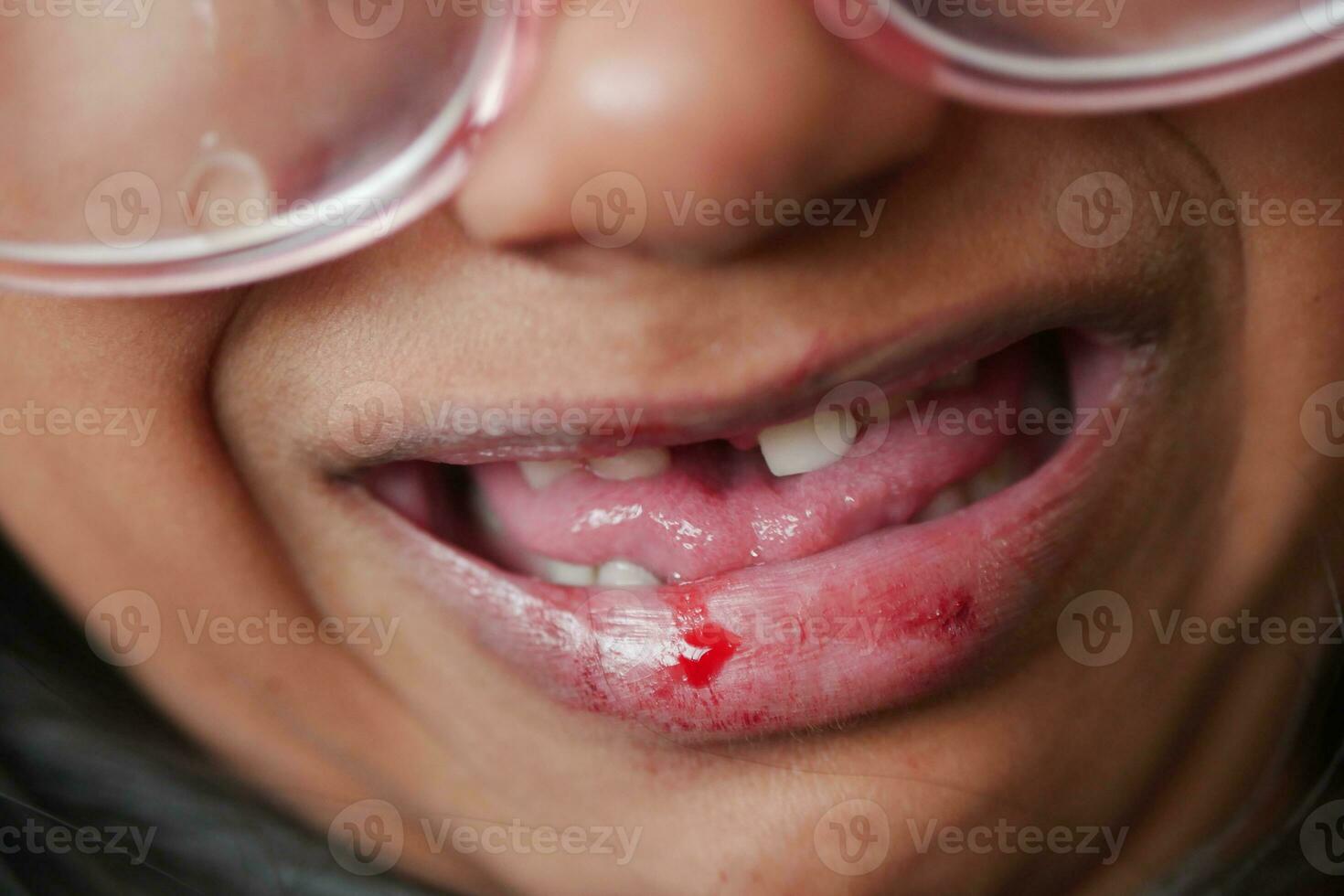 cerca arriba de seco labio de un niño foto