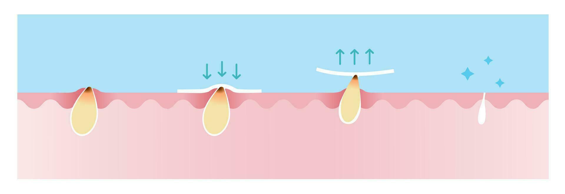 Step of blackhead removal vector illustration on blue sky background. Cross section of blackhead pore strip treatment, apply, peel off, unclogging and tighten pore. Skin care and beauty concept.