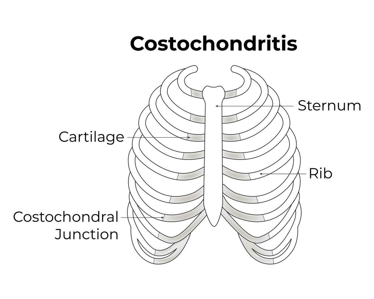 Costochondritis Science Design Vector Illustration 36491319 Vector Art