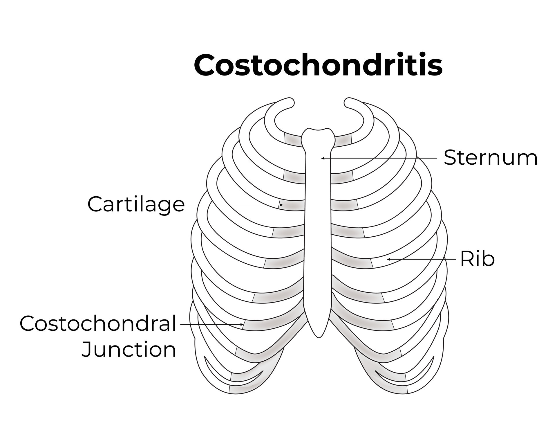 Costochondritis Science Design Vector Illustration 36491319 Vector Art