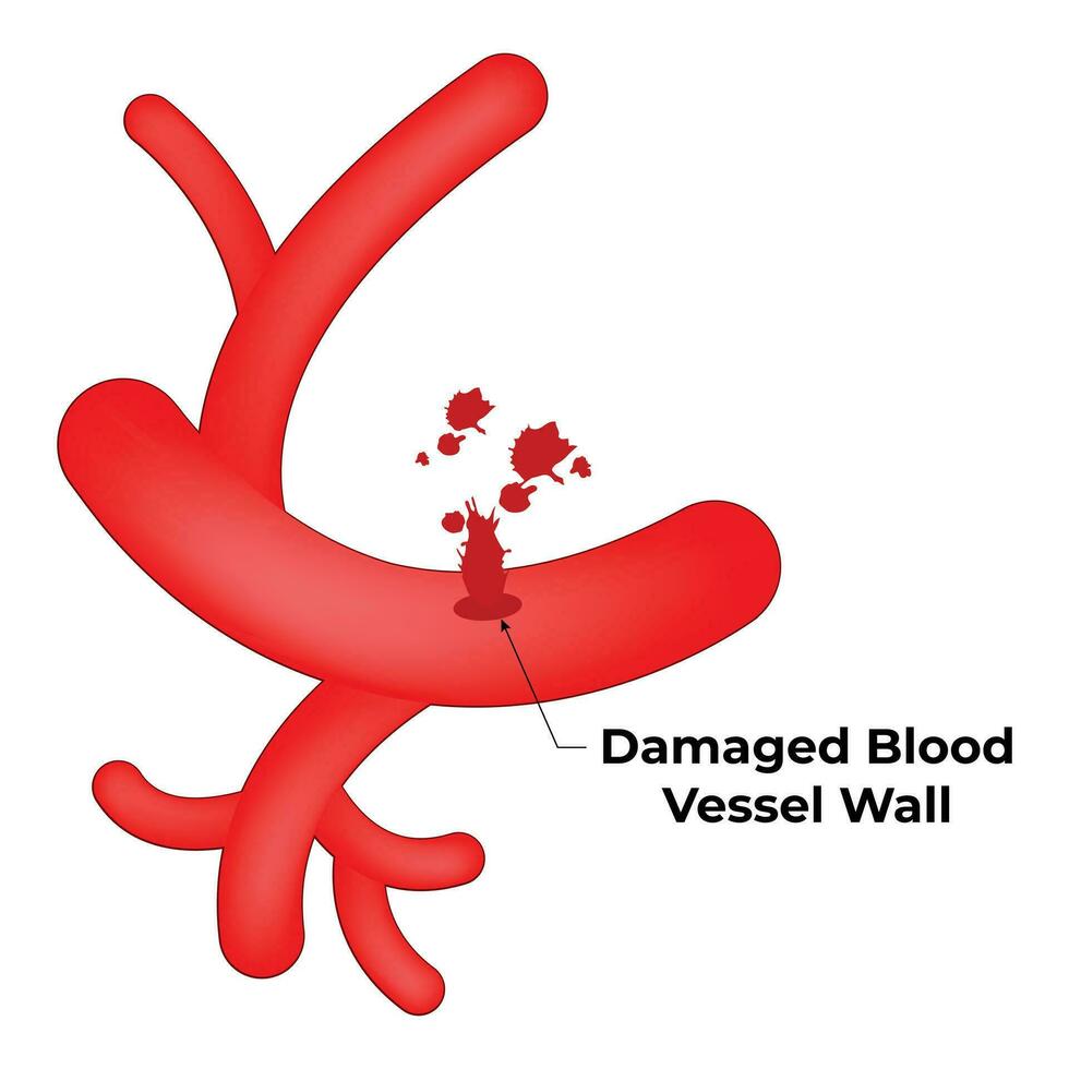 Damaged Blood Vessel Wall Science Design Vector Illustration