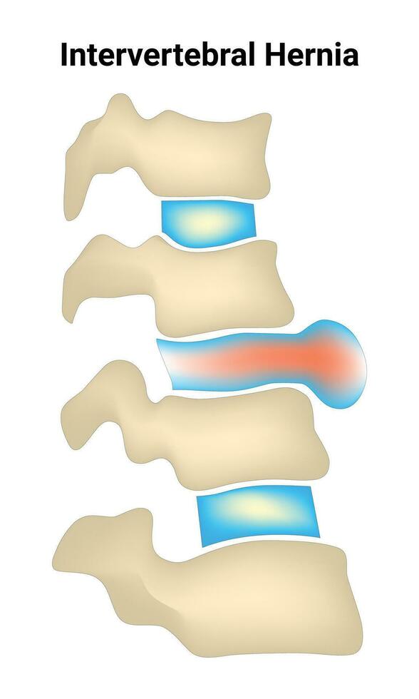 intervertebral hernia Ciencias diseño vector ilustración