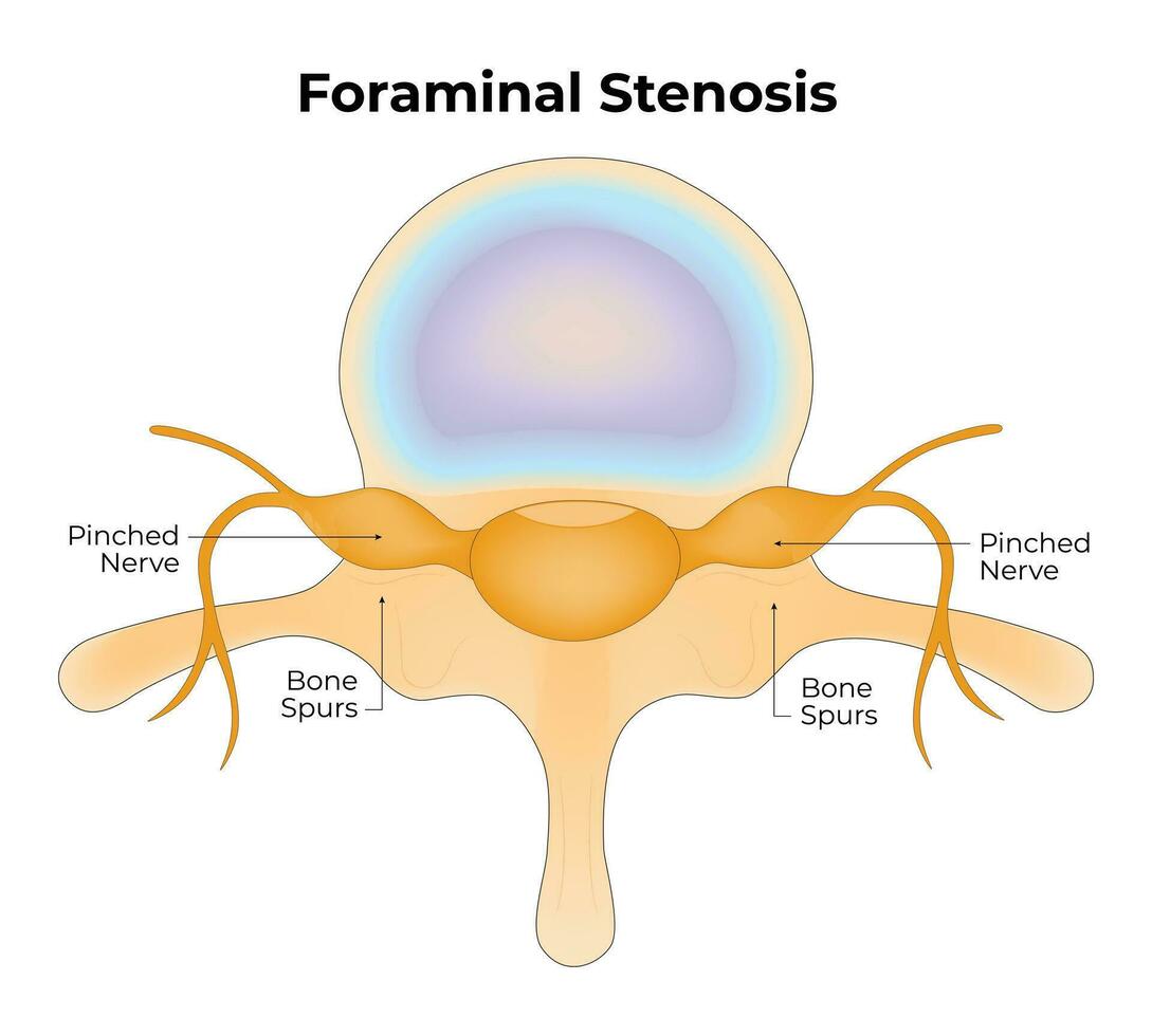 Foraminal Stenosis Science Design Vector Illustration