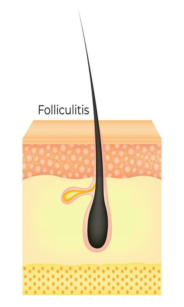 Folliculitis Science Design Vector Illustration Diagram