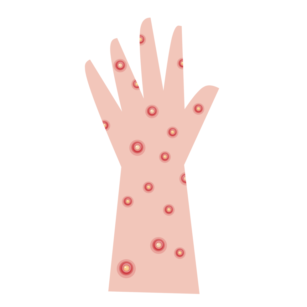 Hand with monkeypox png