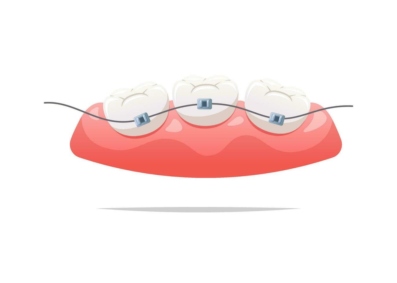 Teeth with braces and gums. Dental health concept. Vector illustration.