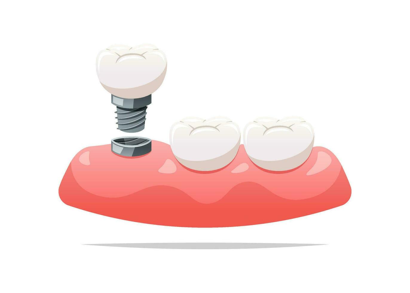 dental implantes y cena. dental salud concepto. vector ilustración.