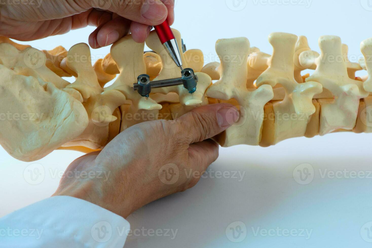 médico demostrando instrumento fijación para lumbar columna vertebral. foto