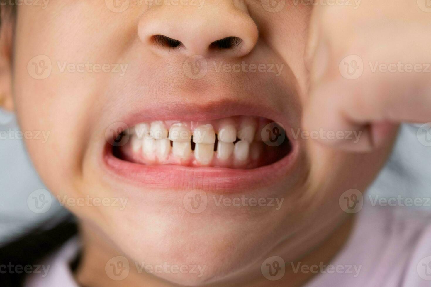 Headshot cropped image of cute preschool girl smiling wide showing milk teeth. Close-up of a child's white teeth. photo