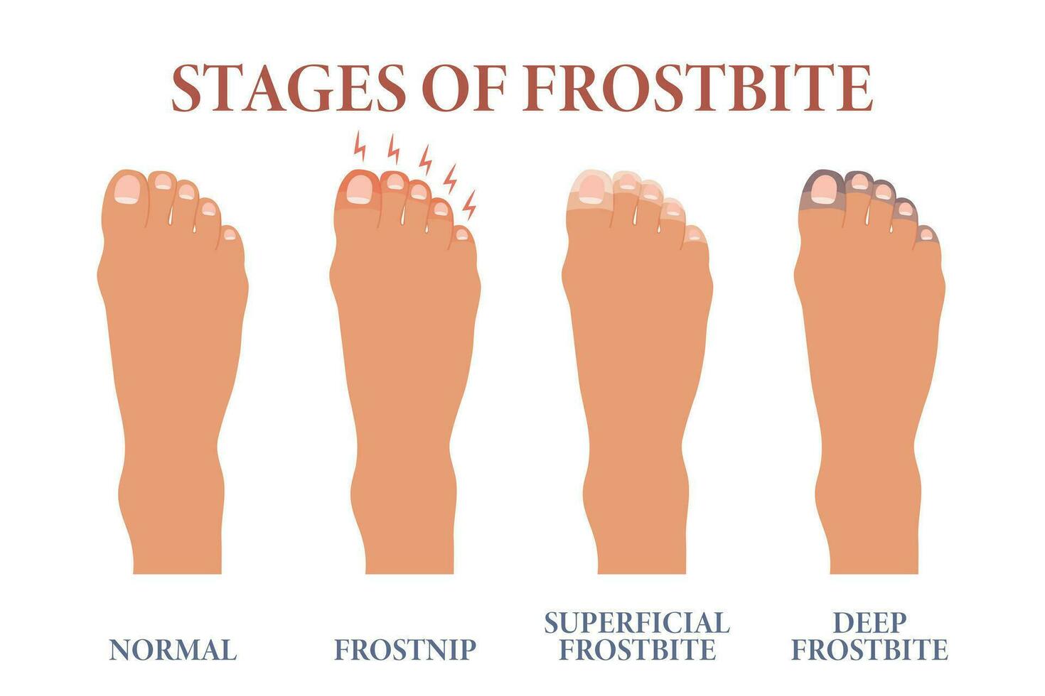 Frozen toes. Stages of frostbite of fingers. Healthcare and medicine. Vector