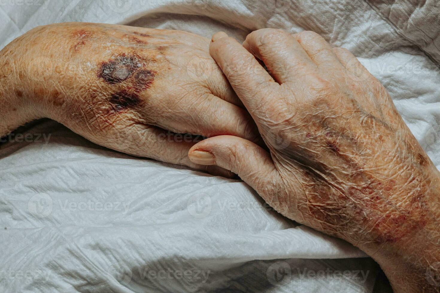 A bruise on the hand of an elderly person. Known as senile purpura. Caused by the fragility of the skin and blood vessels in old age. Elderly care photo