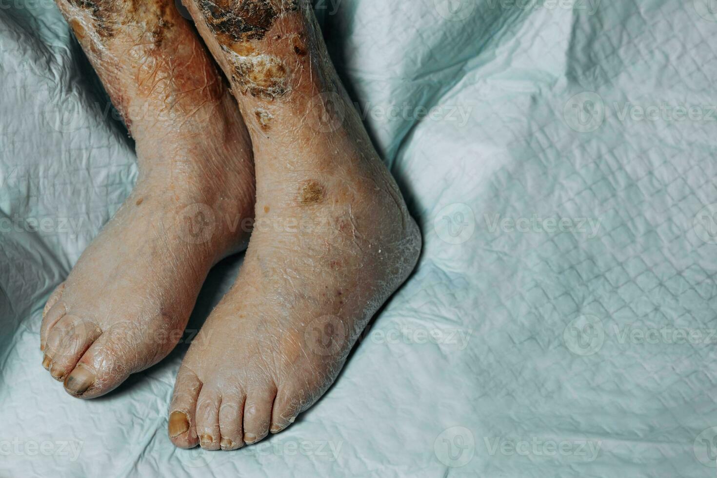 piernas de un mayor mujer con varicoso venas, costra heridas, varicoso las venas y trombosis, mayor persona no caminando, de cerca, flebitis, trombosis foto