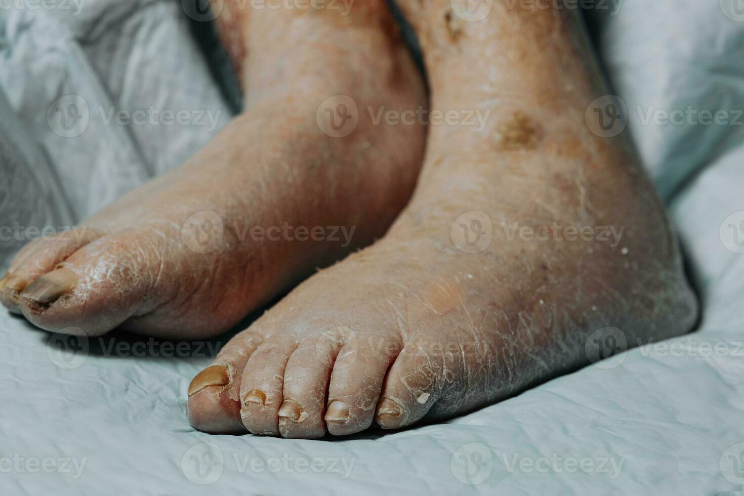 Legs of an elderly woman with varicose veins, scabbed wounds, varicose veins and thrombosis, elderly person not walking, close-up, phlebitis, thrombosis photo