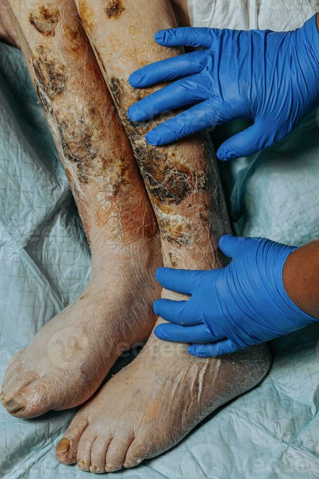 On the legs of an elderly woman, the skin peels off due to eczema, swelling of the legs. Yellowing of the nail plate. Swelling of the legs. Consequences of diabetes in the elderly. Elderly care photo