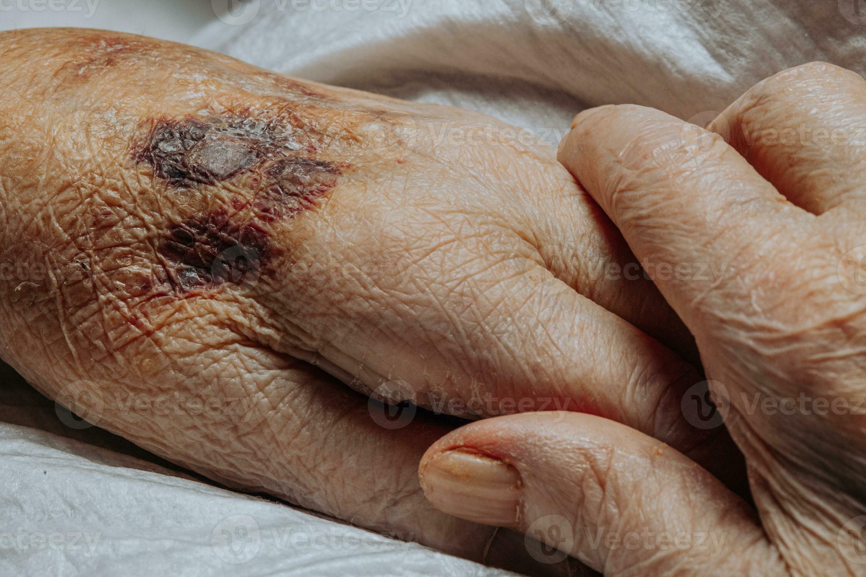 Close-up of an elderly person's hands showing a large purple bruise on the back of the left hand, illustrating senile purpura