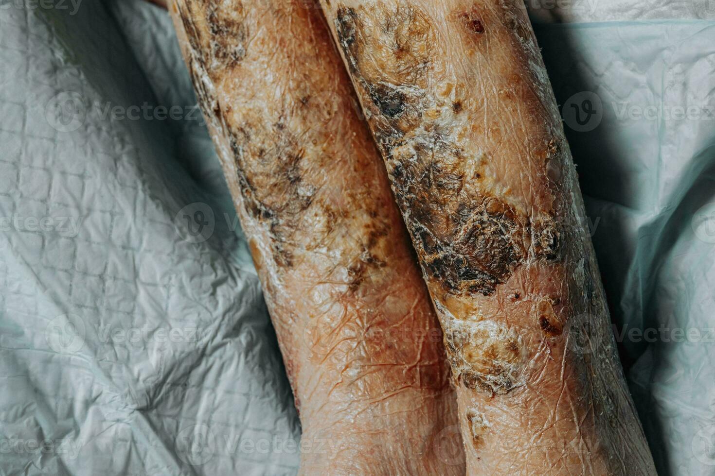 Skin lesions on the leg. Symptoms characteristic of the elderly begin with a red rash in a small circle and spread to a wider area. Large scabs on the legs. Elderly care. Consequences of diabetes photo