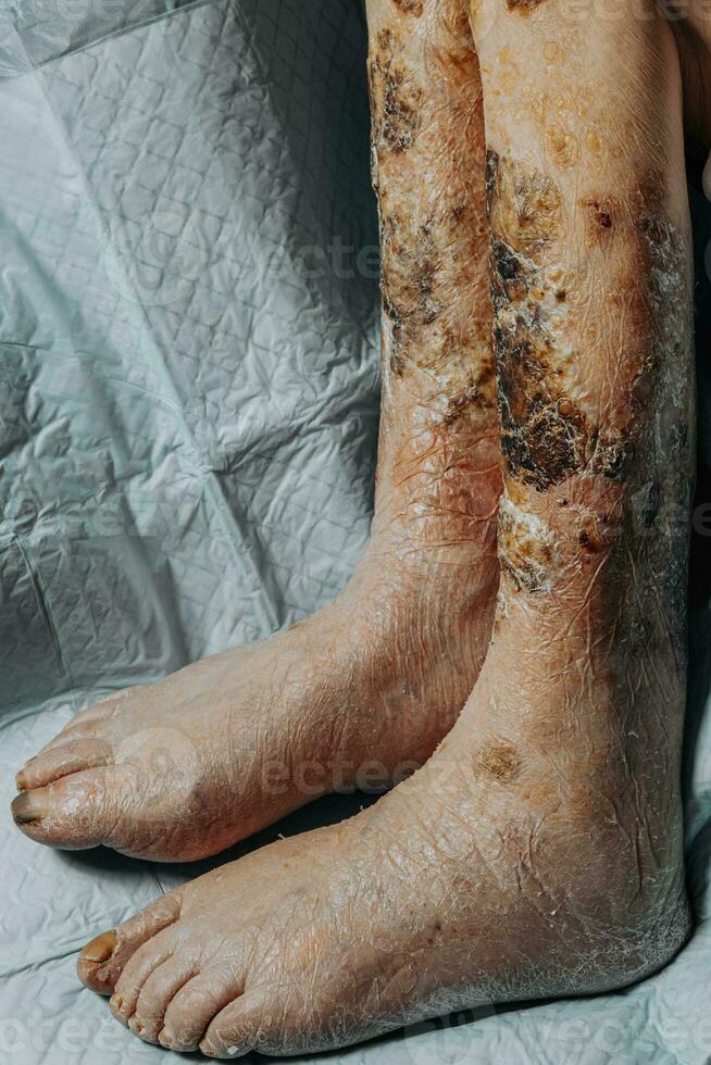 Skin lesions on the leg. Symptoms characteristic of the elderly begin with a red rash in a small circle and spread to a wider area. Large scabs on the legs. Elderly care. Consequences of diabetes photo