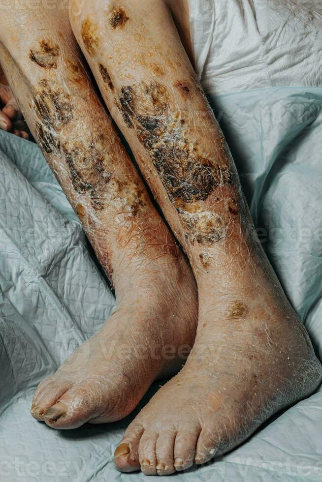 Skin lesions on the leg. Symptoms characteristic of the elderly begin with a red rash in a small circle and spread to a wider area. Large scabs on the legs. Elderly care. Consequences of diabetes photo