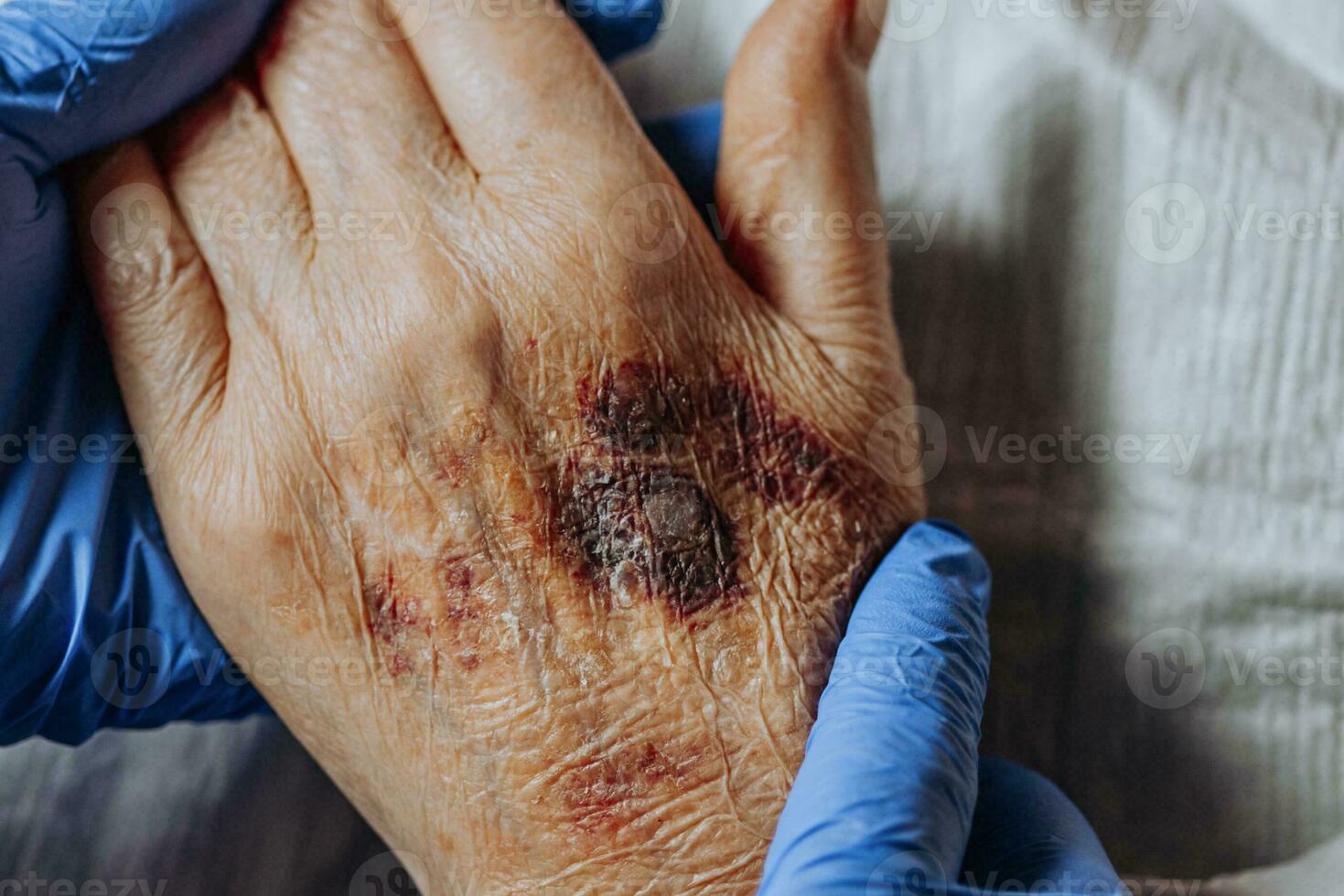 A bruise on the hand of an elderly person. Known as senile purpura. Caused by the fragility of the skin and blood vessels in old age. Elderly care photo