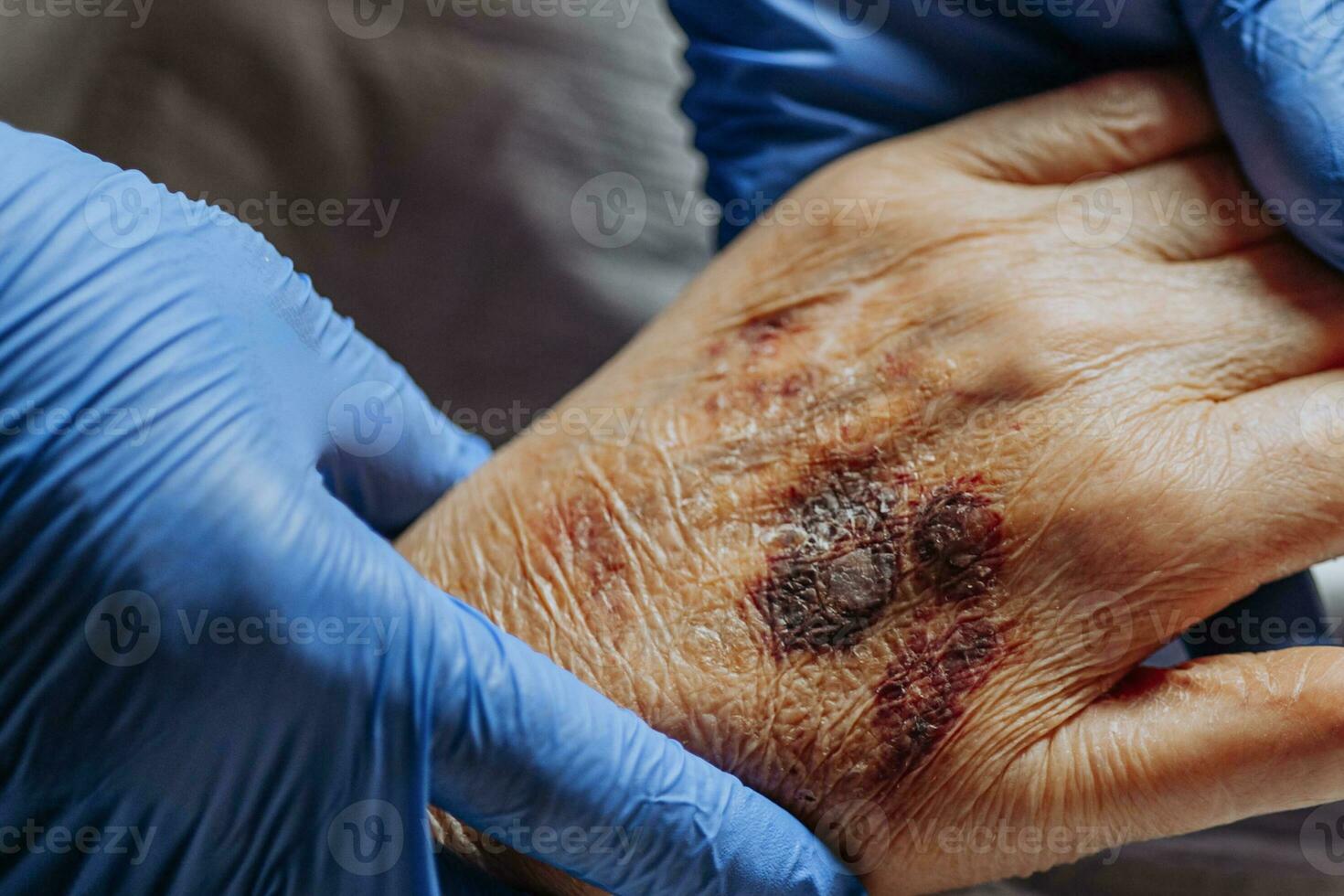 A bruise on the hand of an elderly person. Known as senile purpura. Caused by the fragility of the skin and blood vessels in old age. Elderly care photo