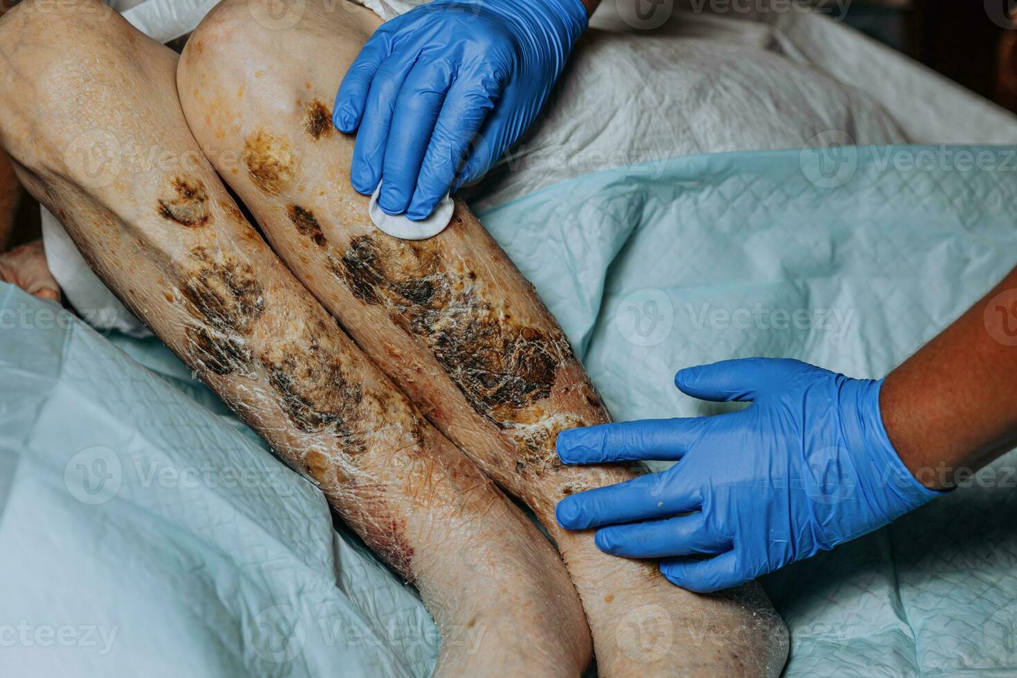 Skin lesions on the leg. Symptoms characteristic of the elderly begin with a red rash in a small circle and spread to a wider area. Large scabs on the legs. Elderly care. Consequences of diabetes photo