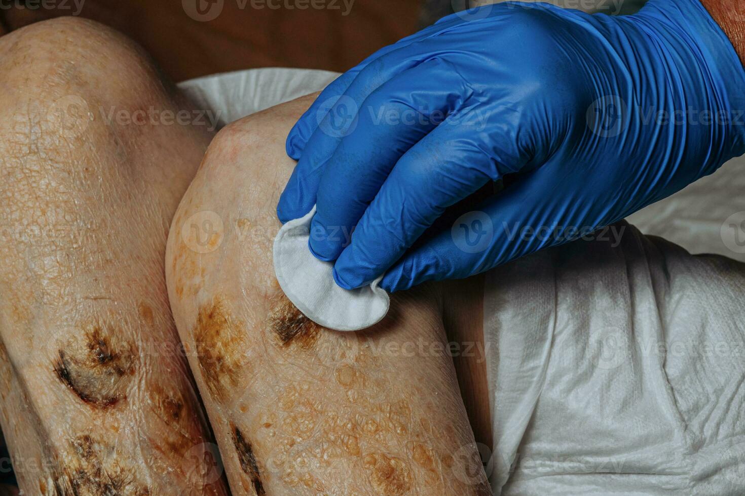 Skin lesions on the leg. Symptoms characteristic of the elderly begin with a red rash in a small circle and spread to a wider area. Large scabs on the legs. Elderly care. Consequences of diabetes photo
