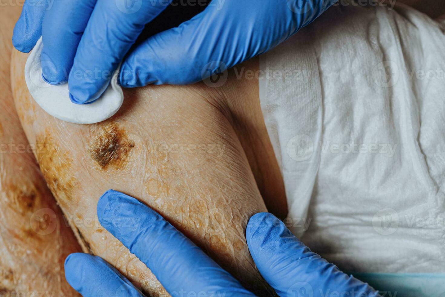 piel lesiones en el pierna. síntomas característica de el mayor empezar con un rojo erupción en un pequeño circulo y untado a un más amplio área. grande costras en el piernas. mayor cuidado. Consecuencias de diabetes foto