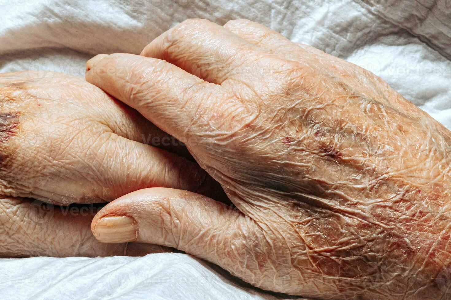 A bruise on the hand of an elderly person. Known as senile purpura. Caused by the fragility of the skin and blood vessels in old age. Elderly care photo