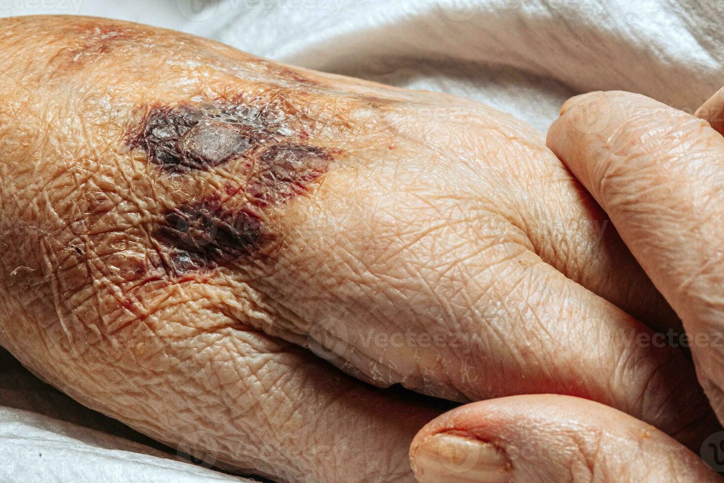 A bruise on the hand of an elderly person. Known as senile purpura. Caused by the fragility of the skin and blood vessels in old age. Elderly care photo