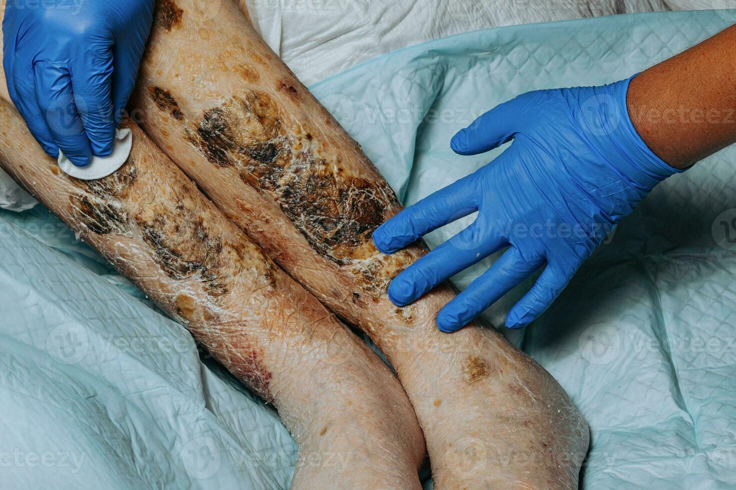 Skin lesions on the leg. Symptoms characteristic of the elderly begin with a red rash in a small circle and spread to a wider area. Large scabs on the legs. Elderly care. Consequences of diabetes photo