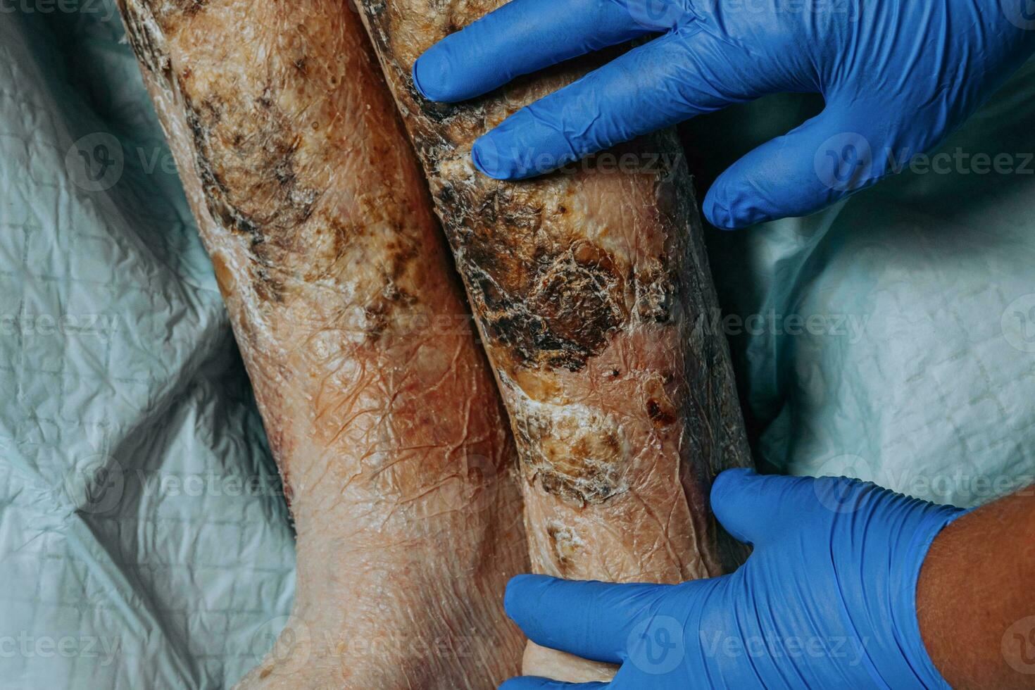 On the legs of an elderly woman, the skin peels off due to eczema, swelling of the legs. Yellowing of the nail plate. Swelling of the legs. Consequences of diabetes in the elderly. Elderly care photo