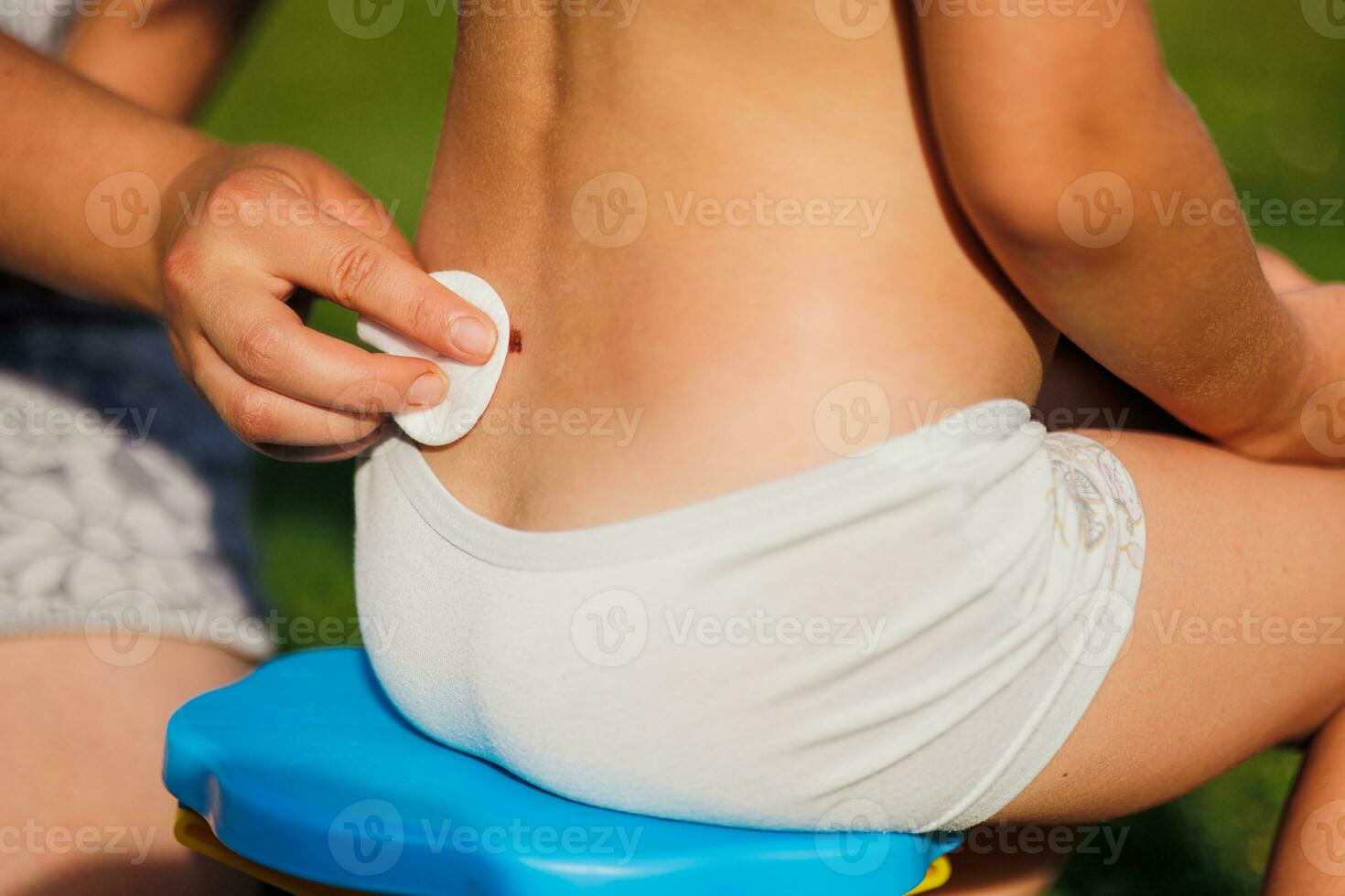 A woman's hand heals a wound on a child's back. A child sits on a chair in the summer. Treatment of the wound. First aid. Close-up photo. photo