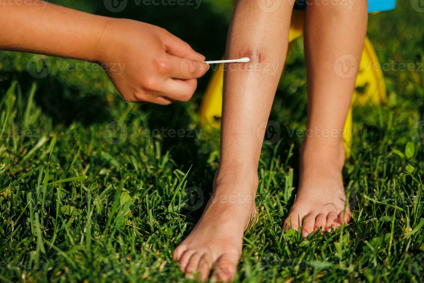 A woman's hand treats a child's wound under the knee with a disinfectant. A child sits on a chair and green grass in the summer. Treatment of the wound. First aid. Cropped photo
